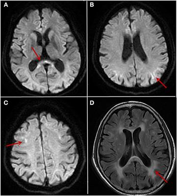 Case Report: <mark class="highlighted">Neuronal Intranuclear Inclusion Disease</mark> With Oromandibular Dystonia Onset